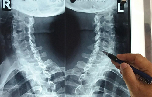 hẹp lỗ liên hợp đốt sống cổ