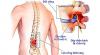 Cách chữa thoát vị đĩa đệm thắt lưng rất nhanh chỉ 20 Phút
